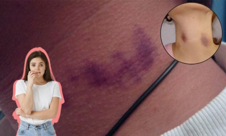 Marca de un chupetón en el cuello y sus posibles riesgos para la salud